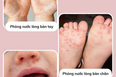 Phòng chống bệnh Tay – chân  – miệng cho trẻ